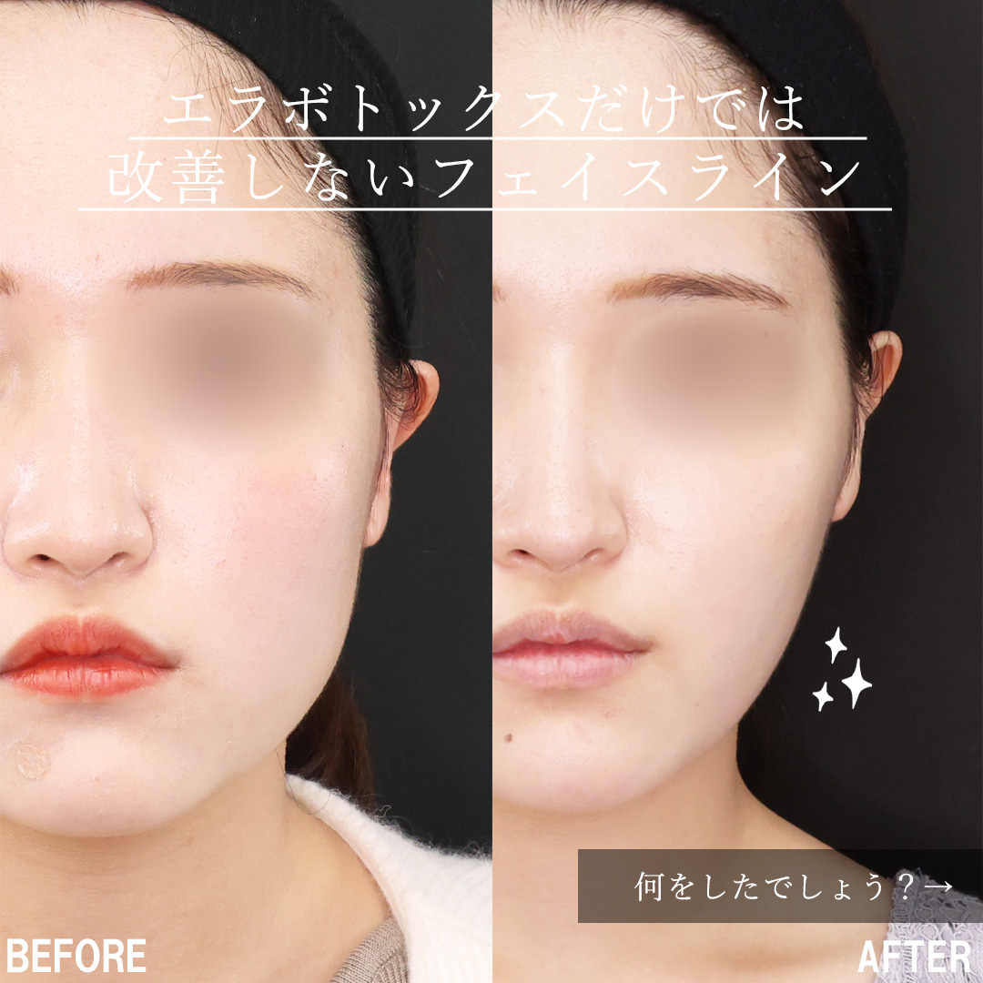 TAC式 ツヤ肌コラーゲンリフト®/Lラインファット除去（エラ下脂肪除去）/顔の脂肪吸引の症例写真 施術前後 