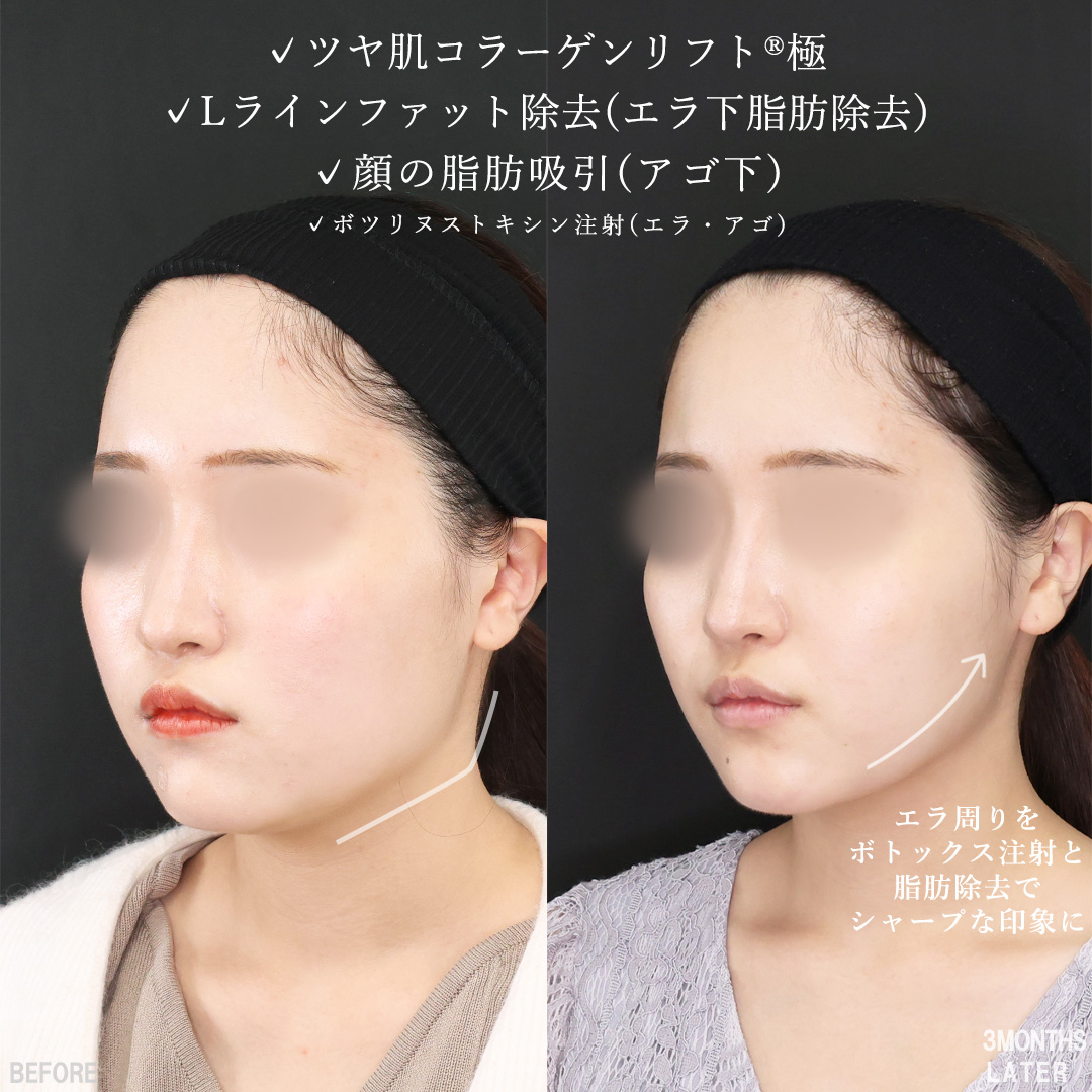 TAC式 ツヤ肌コラーゲンリフト®/Lラインファット除去（エラ下脂肪除去）/顔の脂肪吸引の症例写真 施術前後 