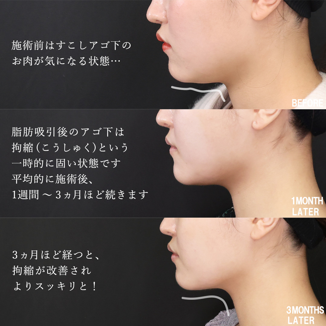 TAC式 ツヤ肌コラーゲンリフト®/Lラインファット除去（エラ下脂肪除去）/顔の脂肪吸引の症例写真 施術前後 