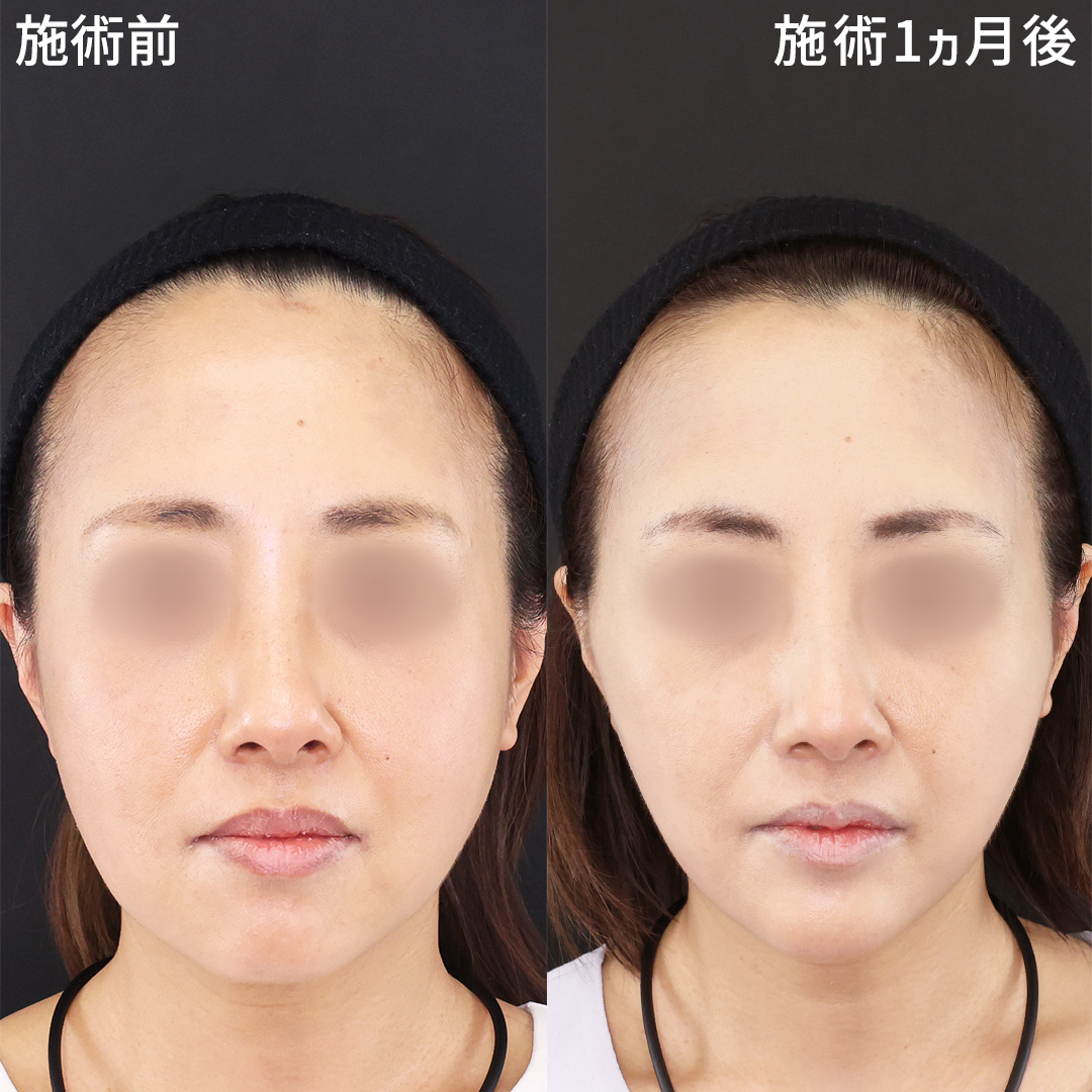 TAC式 ツヤ肌コラーゲンリフト®/TAC式 ショッピングリフト/ジョールファット除去の症例写真 施術前後
