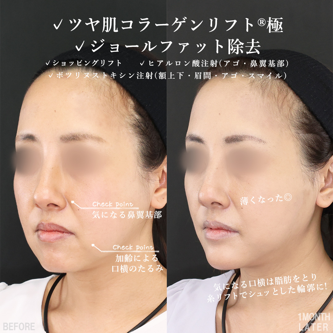 TAC式 ツヤ肌コラーゲンリフト®/TAC式 ショッピングリフト/ジョールファット除去の症例写真 施術前後