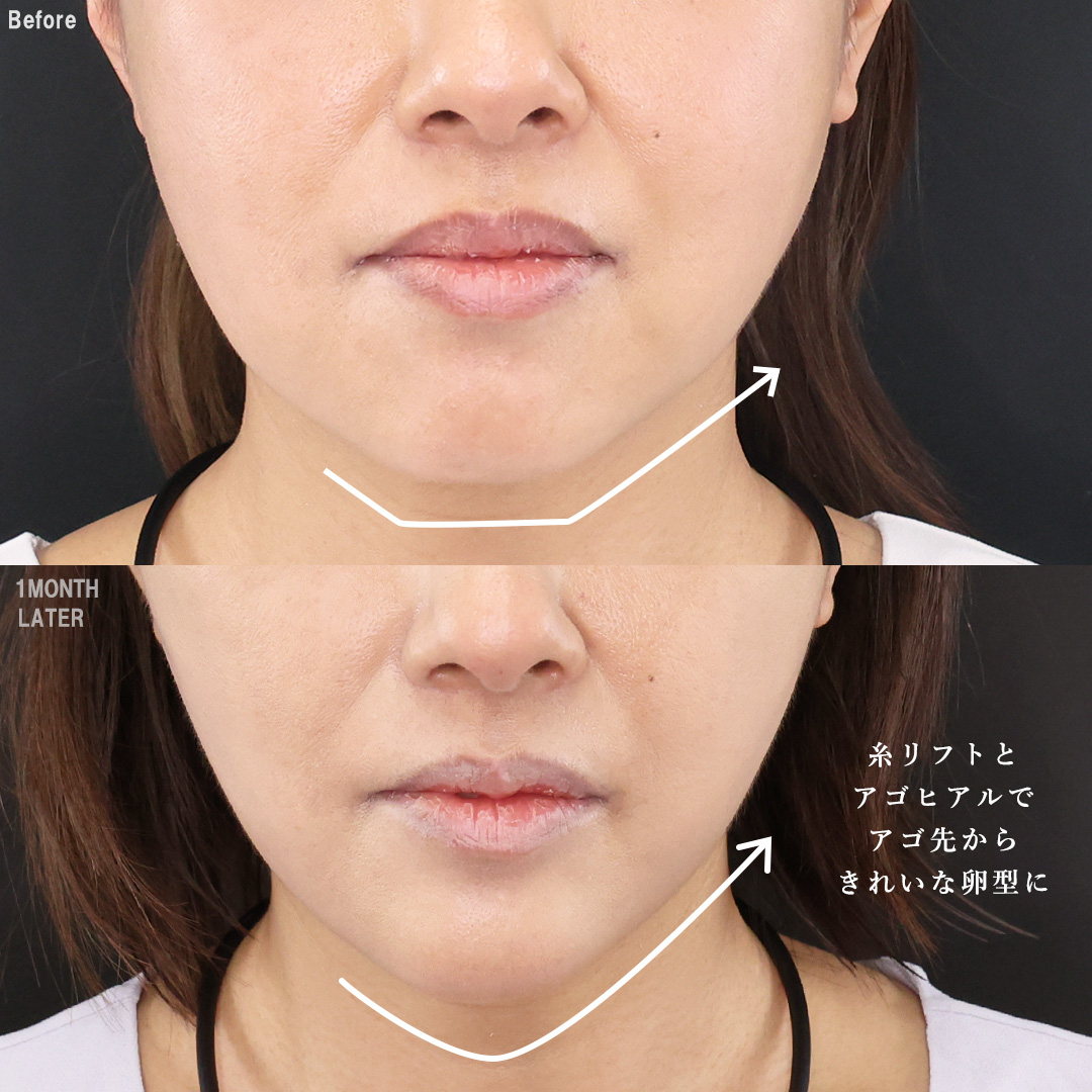 TAC式 ツヤ肌コラーゲンリフト®/TAC式 ショッピングリフト/ジョールファット除去の症例写真 施術前後