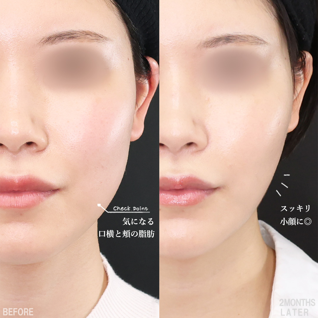 TAC式 ツヤ肌コラーゲンリフト®/TAC式 ショッピングリフト/ジョールファット除去の症例写真 施術前後 