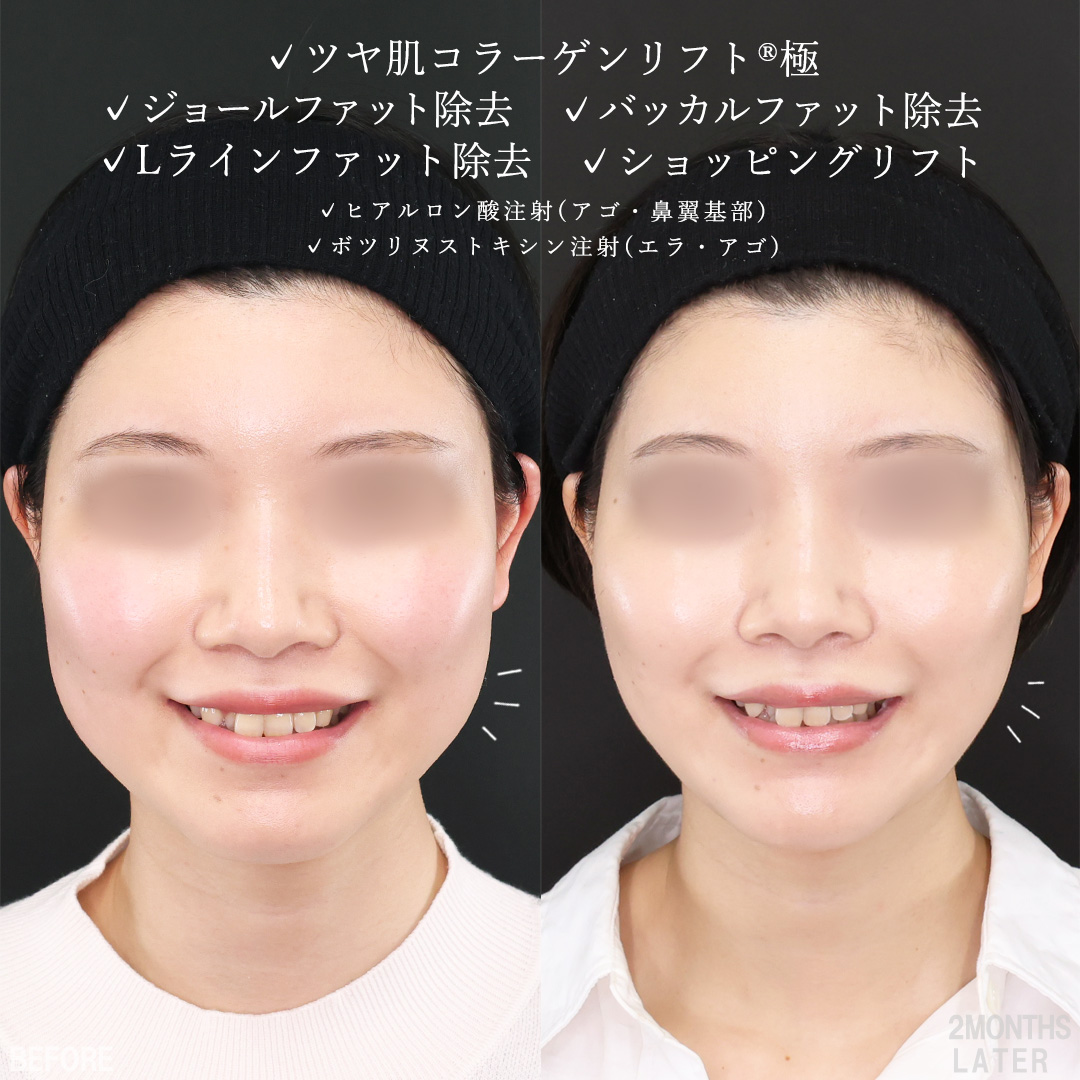 TAC式 ツヤ肌コラーゲンリフト®/TAC式 ショッピングリフト/ジョールファット除去の症例写真 施術前後 