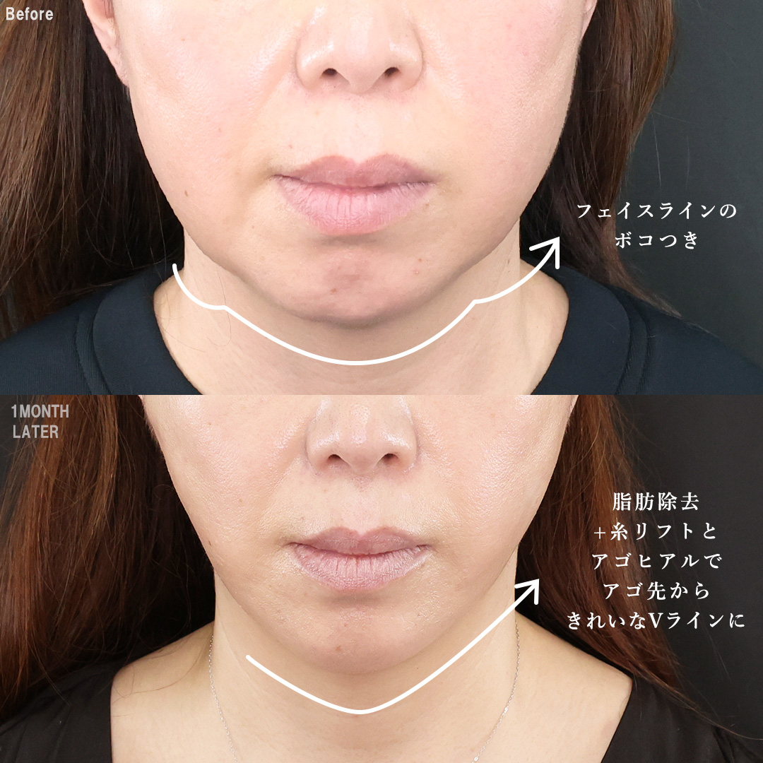 TAC式 ツヤ肌コラーゲンリフト®/ジョールファット除去/Lラインファット除去（エラ下脂肪除去）の症例写真 施術前後 