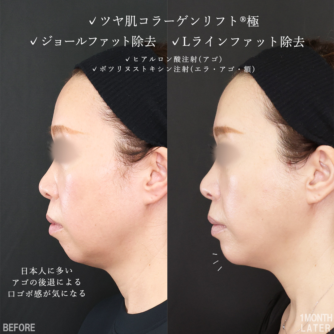 TAC式 ツヤ肌コラーゲンリフト®/ジョールファット除去/Lラインファット除去（エラ下脂肪除去）の症例写真 施術前後 
