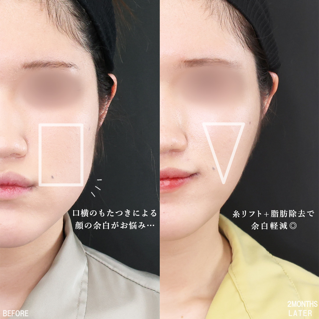 TAC式 ツヤ肌コラーゲンリフト®/ジョールファット除去/バッカルファット除去の症例写真 施術前後 