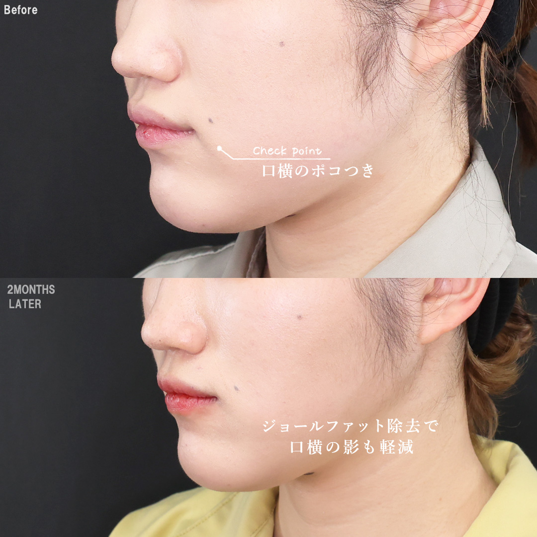 TAC式 ツヤ肌コラーゲンリフト®/ジョールファット除去/バッカルファット除去の症例写真 施術前後 
