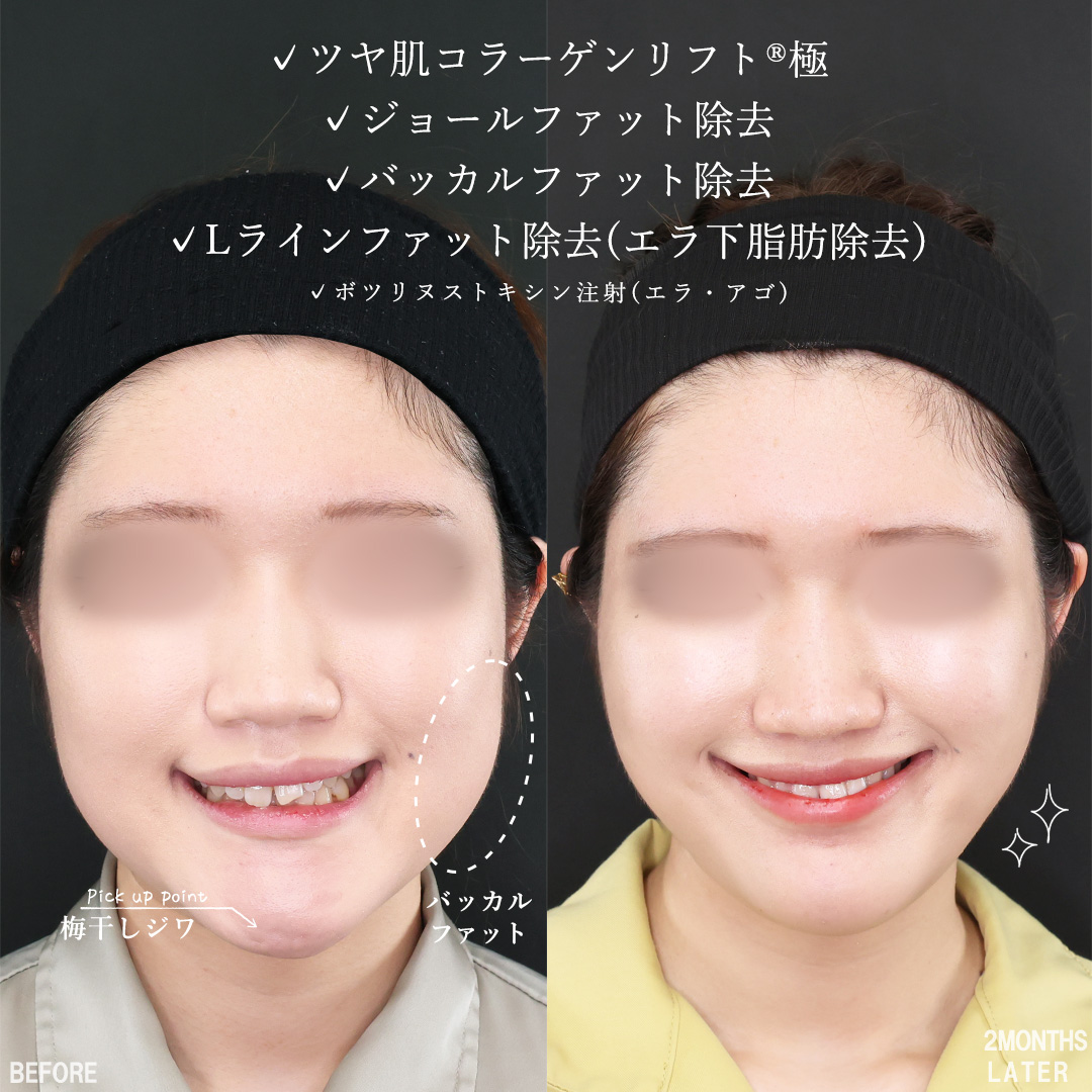 TAC式 ツヤ肌コラーゲンリフト®/ジョールファット除去/バッカルファット除去の症例写真 施術前後 
