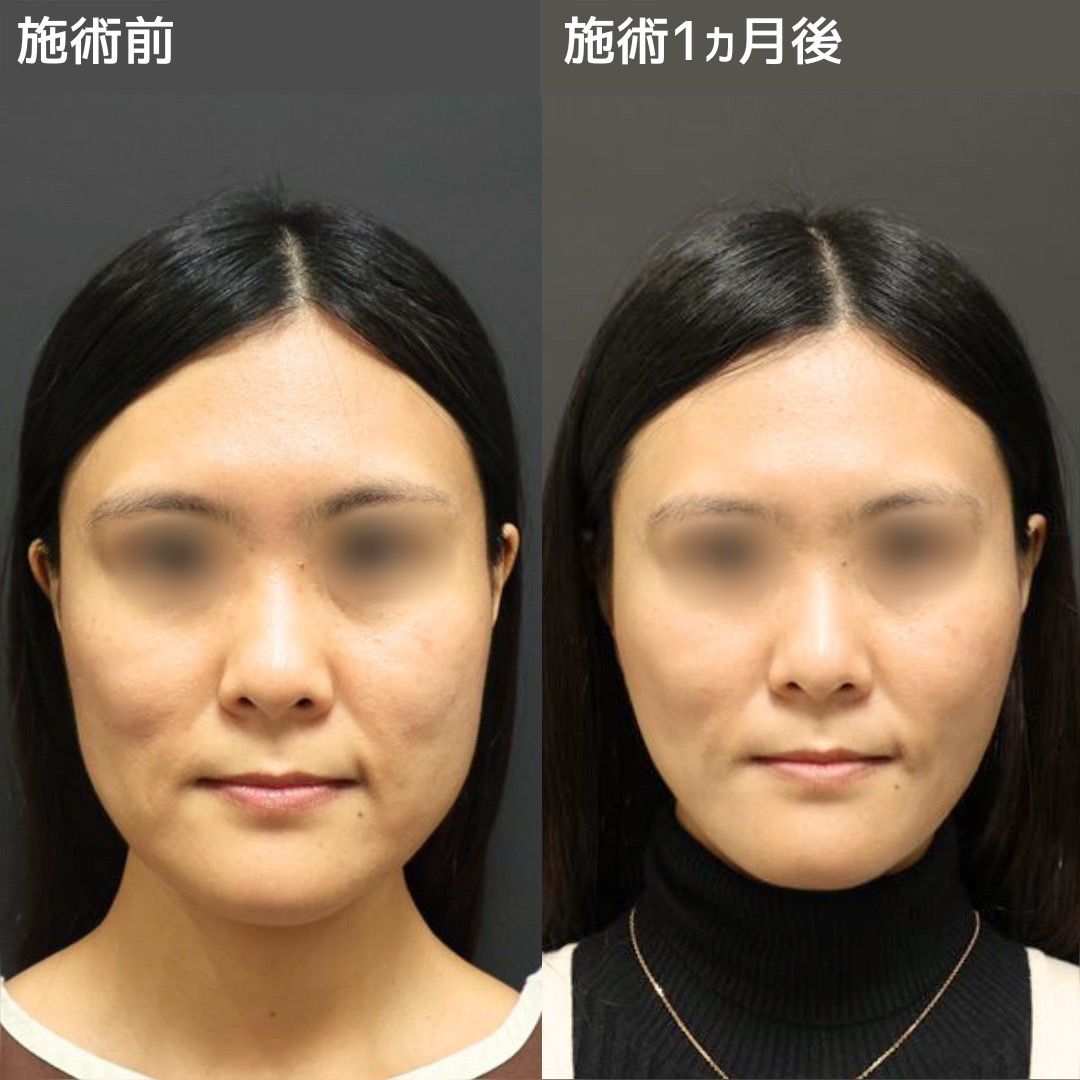 《小顔整形》綺麗な卵型フェイス