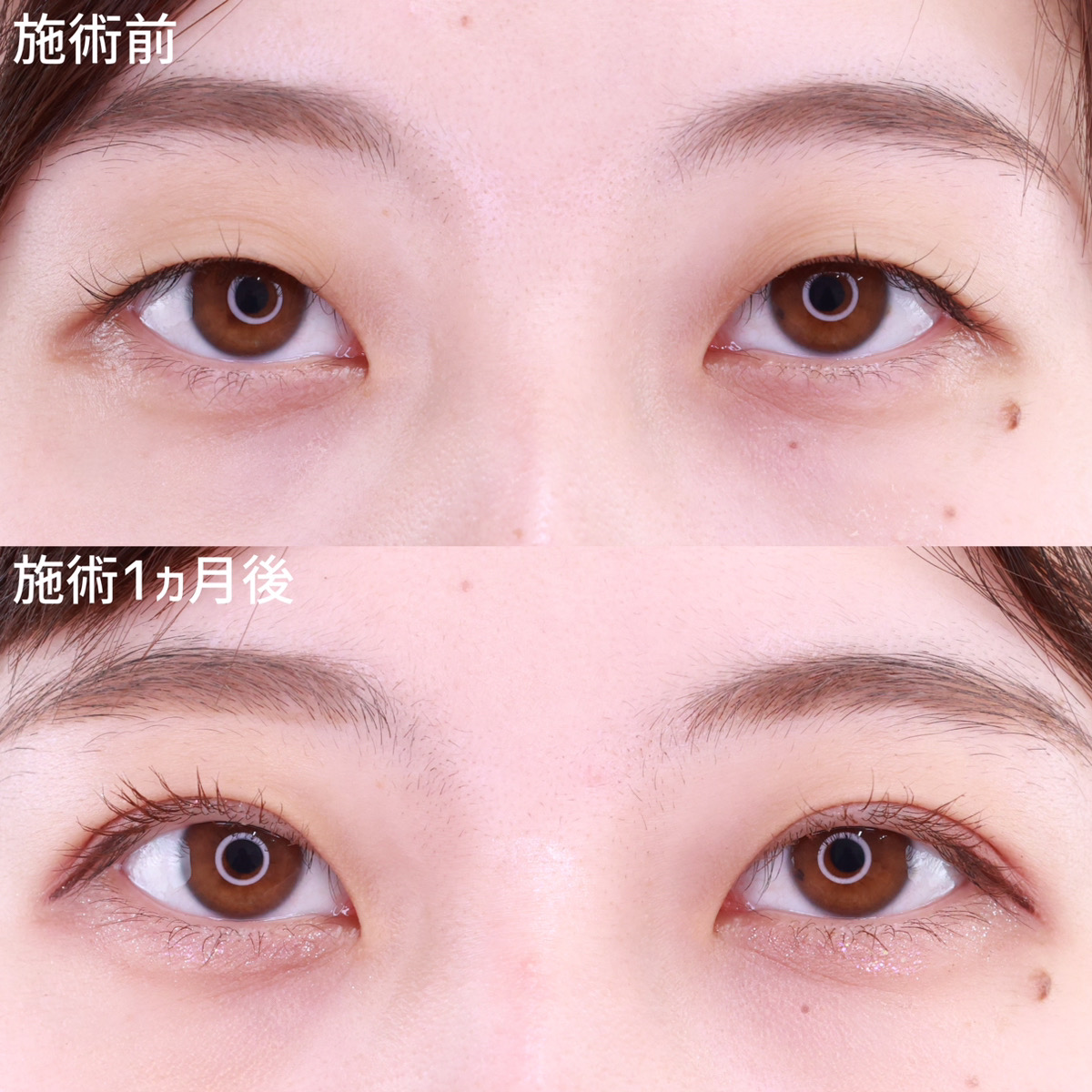 【二重埋没法】自分に似合う二重に変身！