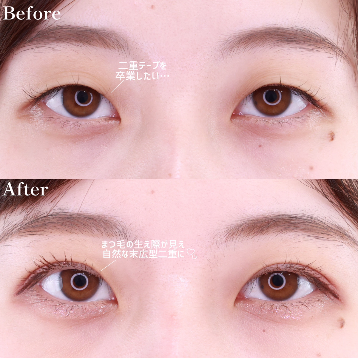 二重埋没法/目元：その他の症例写真 施術前後 