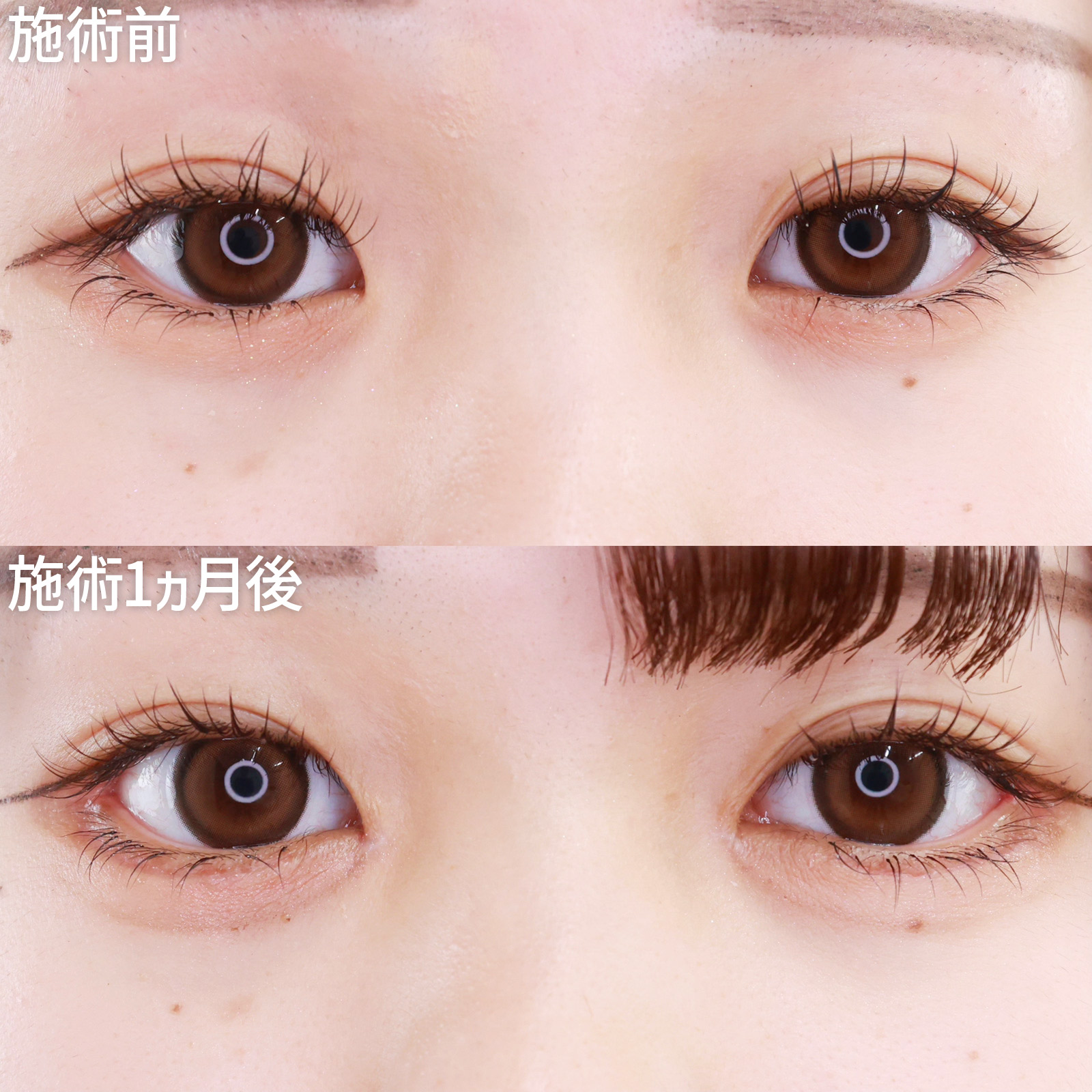 【目元複合施術】グラマラスラインなど計4つの施術でナチュラルなデカ目形成！