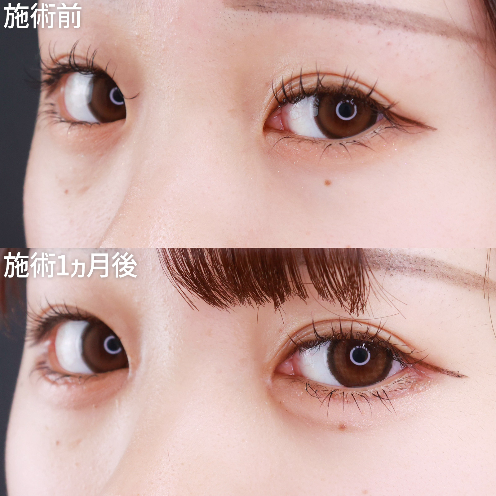 目頭切開術/目尻靭帯移動術/目尻切開術の症例写真 施術前後 