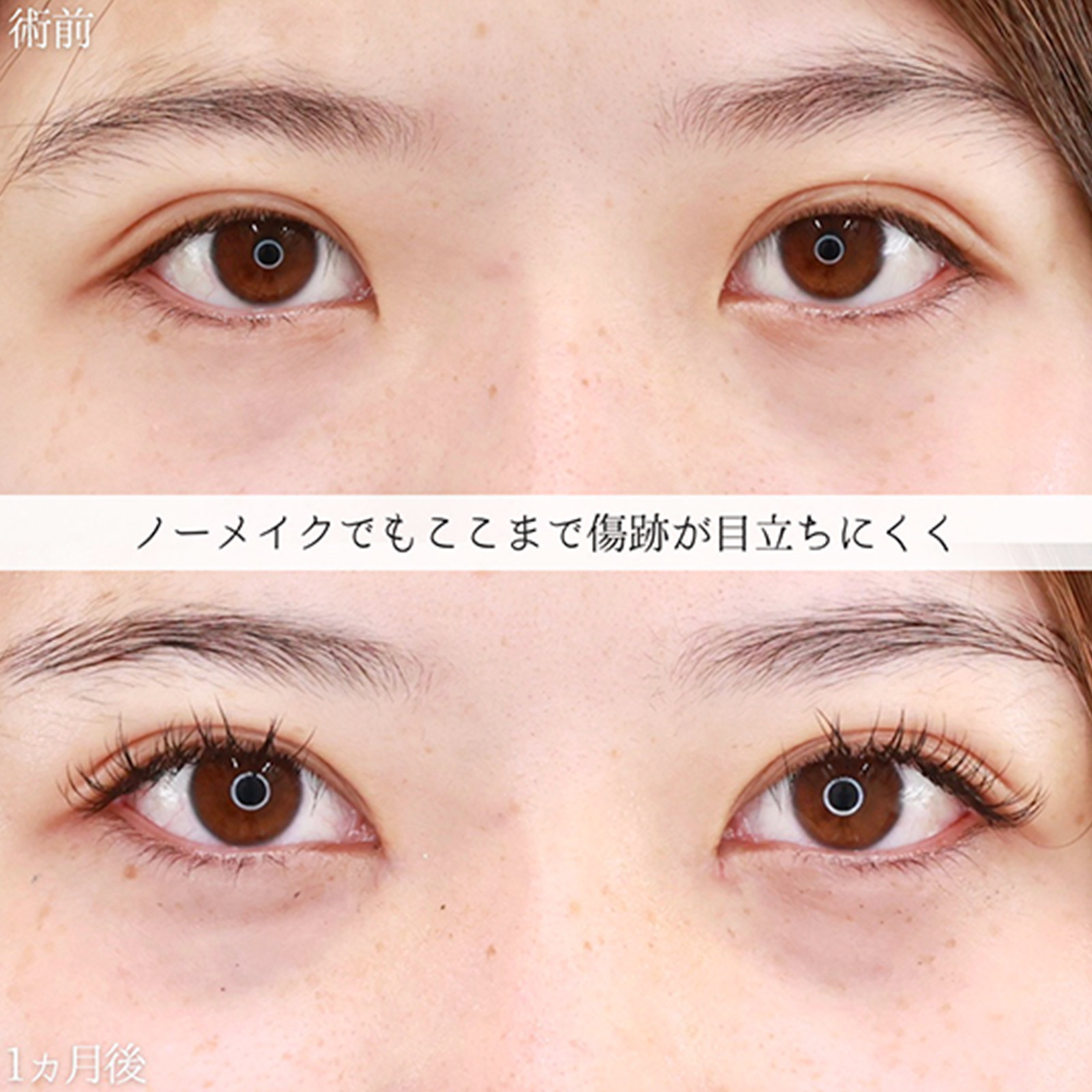 目頭切開術の症例写真 施術前後 