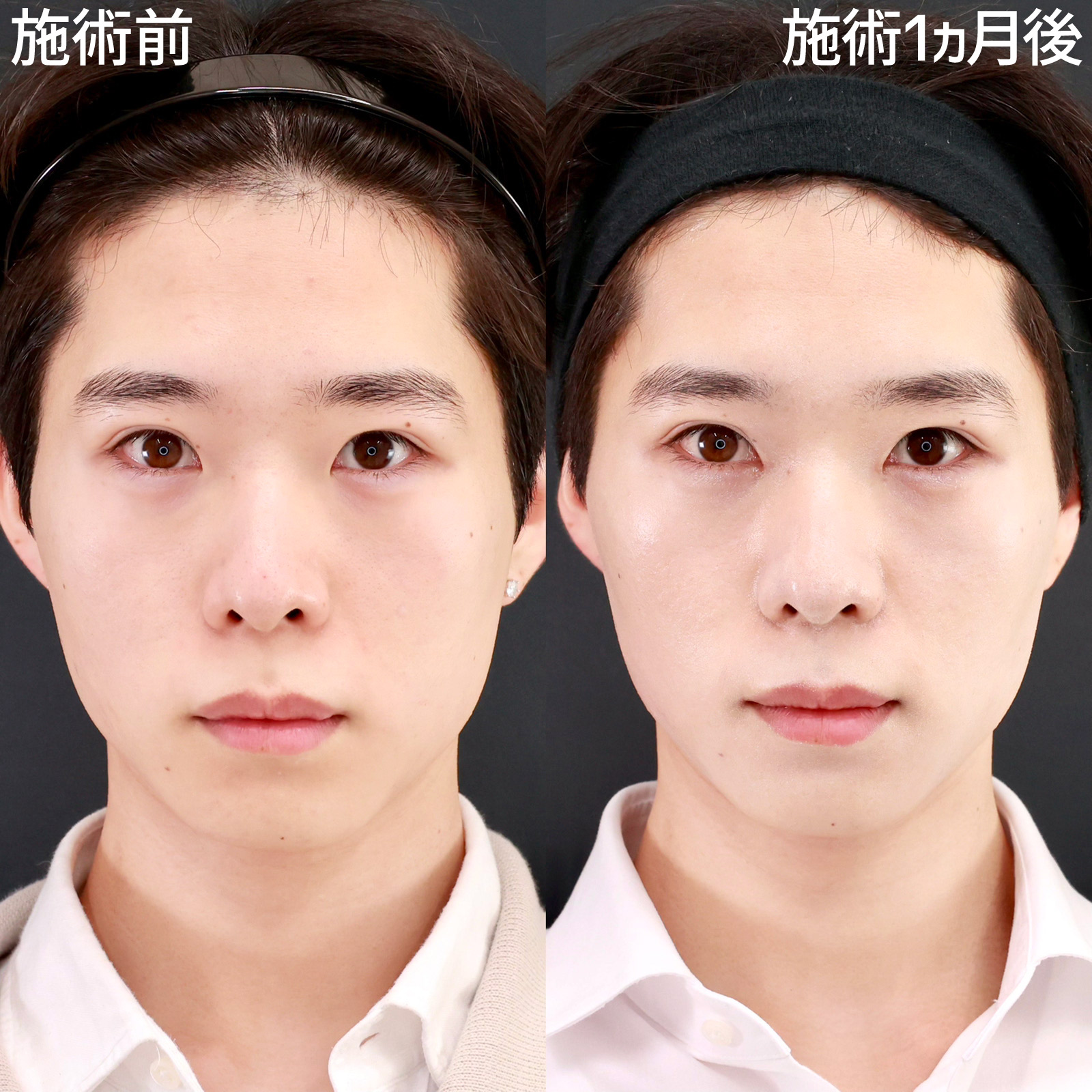 【目頭切開】Z法でしっかり変化を出しつつ、自然に目元を大きく