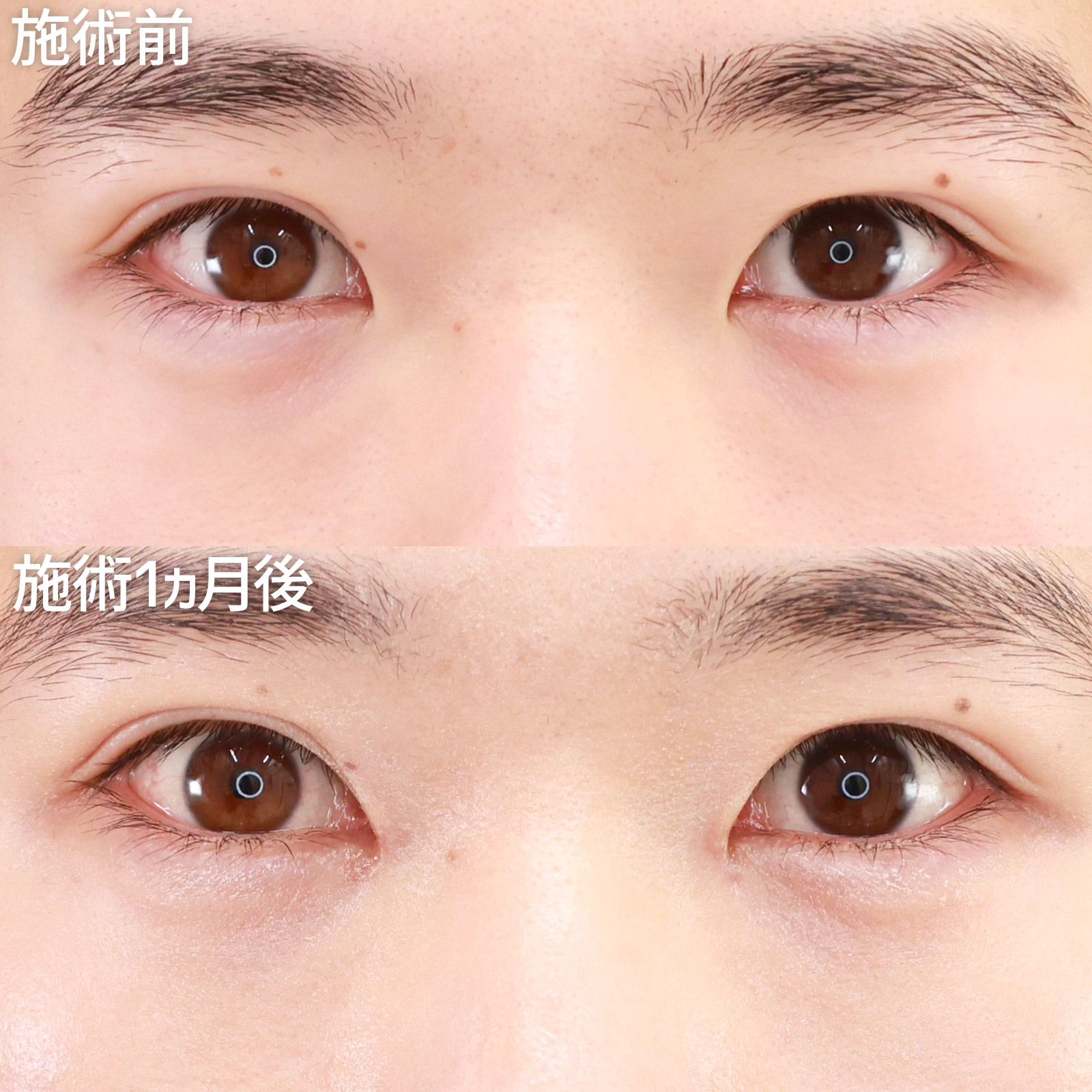 目頭切開術の症例写真 施術前後 