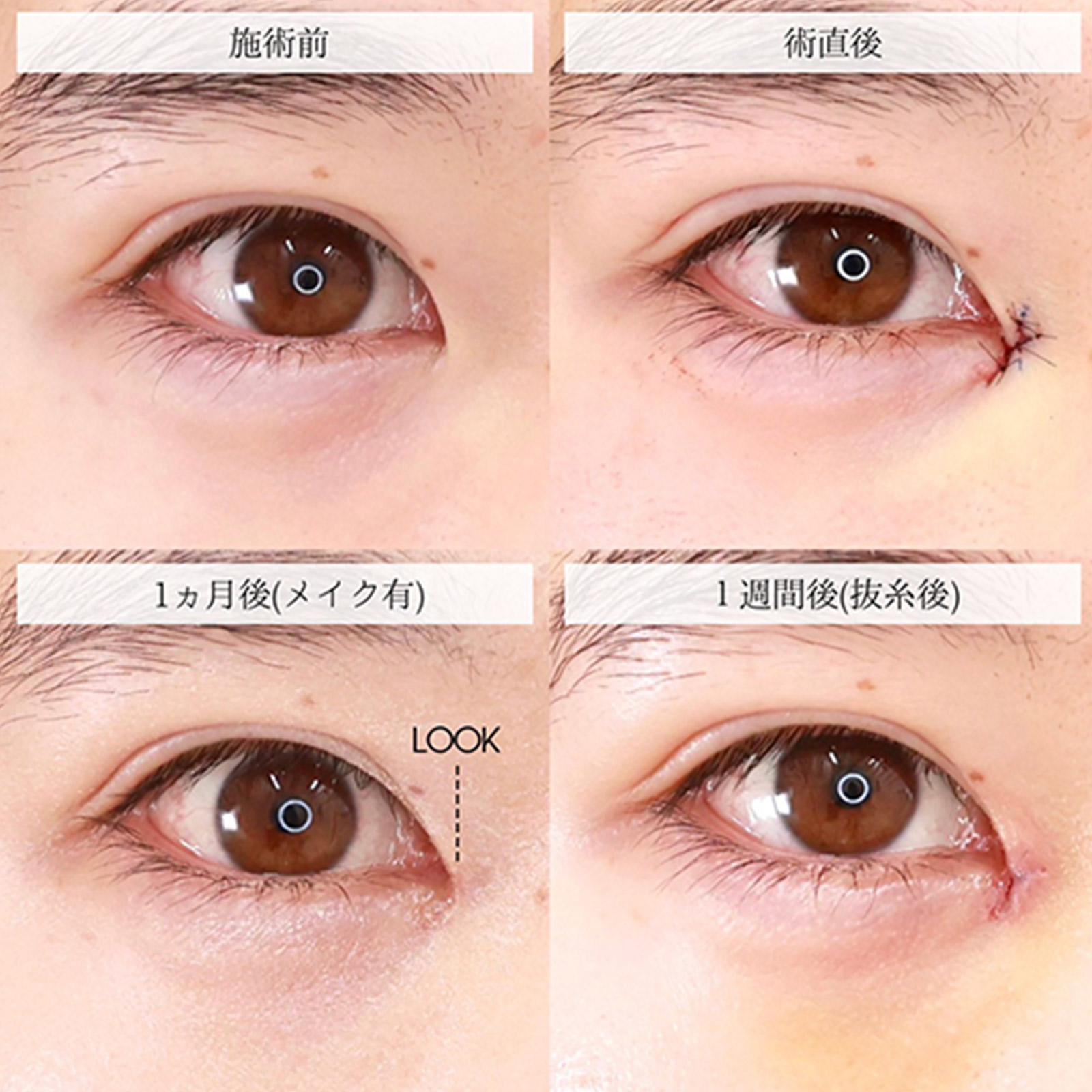 目頭切開術の症例写真 施術前後 