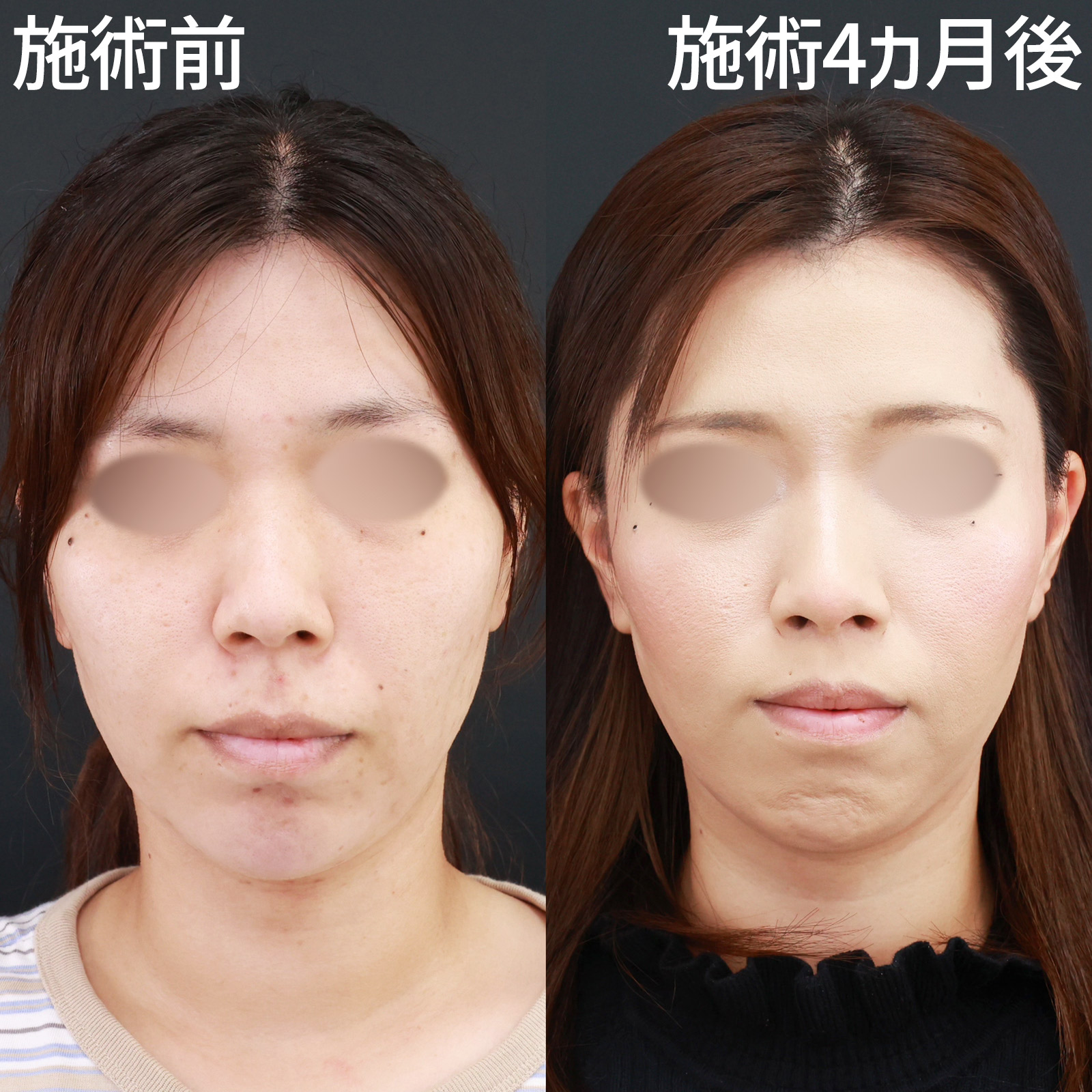 【人中短縮】外側人中短縮との組み合わせで人中を全体的に短く！