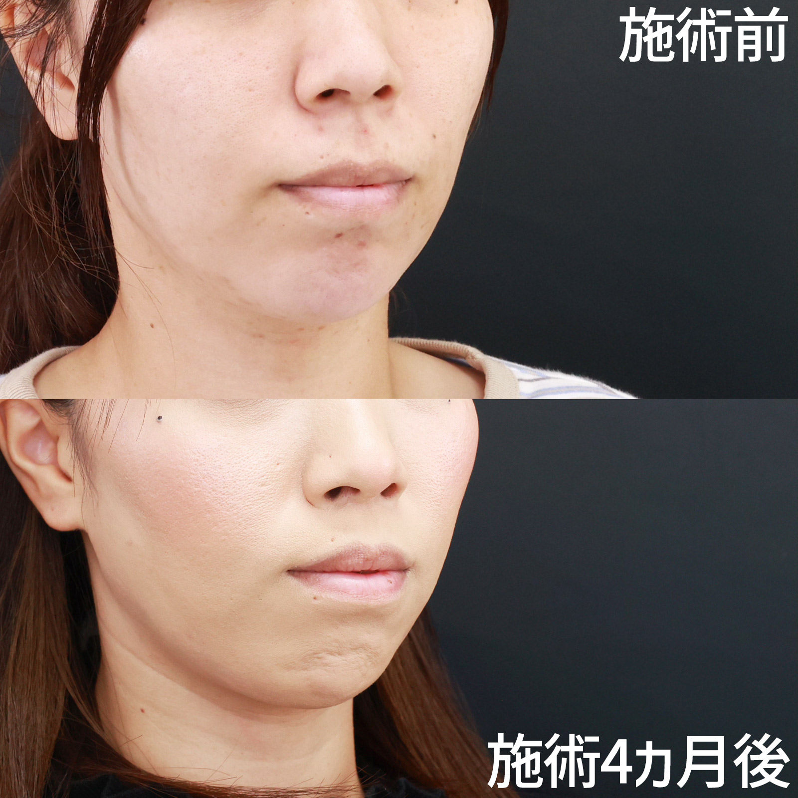 人中短縮術(リップリフト)・外側人中短縮術の症例写真 施術前後 