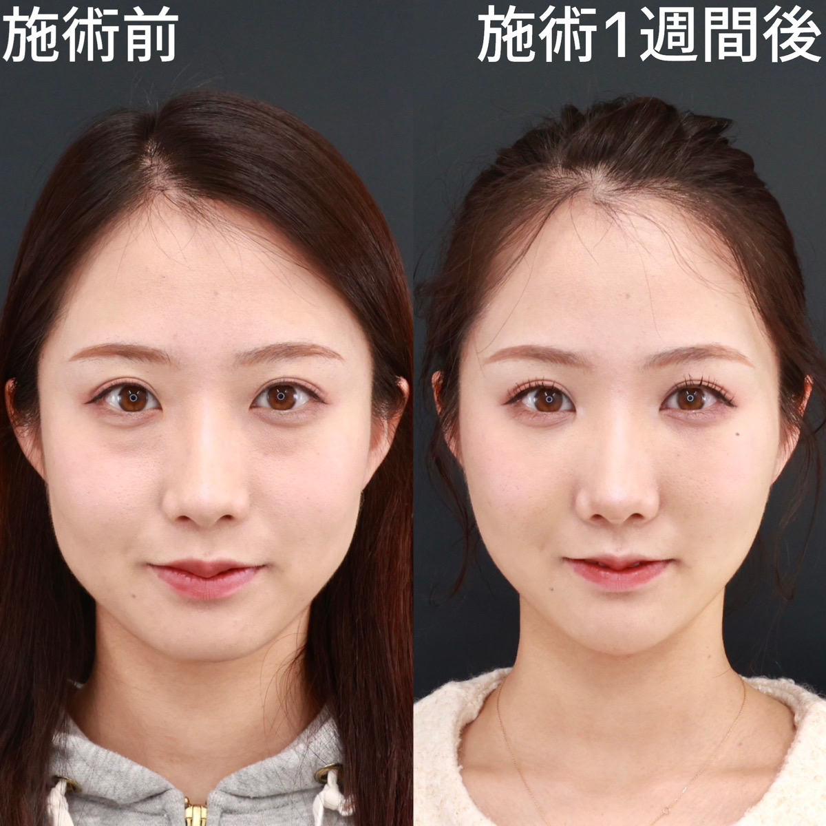 【糸リフト×下眼瞼脱脂術】小顔整形と目の下のふくらみ取りで垢抜けた印象に！