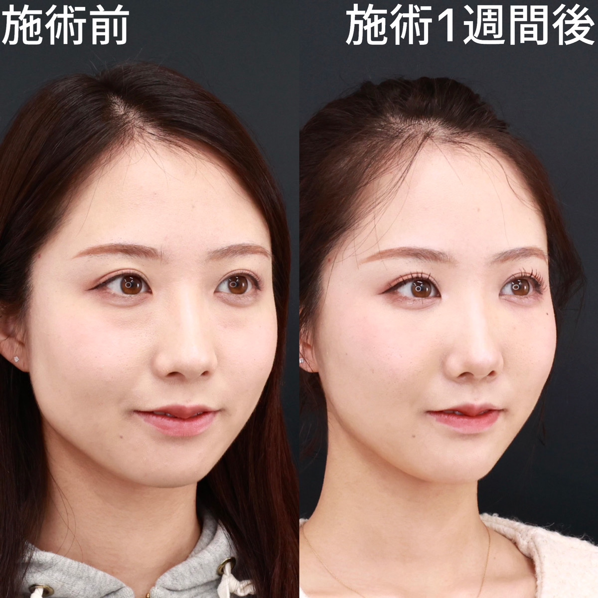 TAC式 ツヤ肌コラーゲンリフト®/エラボトックス注射/顎のヒアルロン酸注射の症例写真 施術前後 