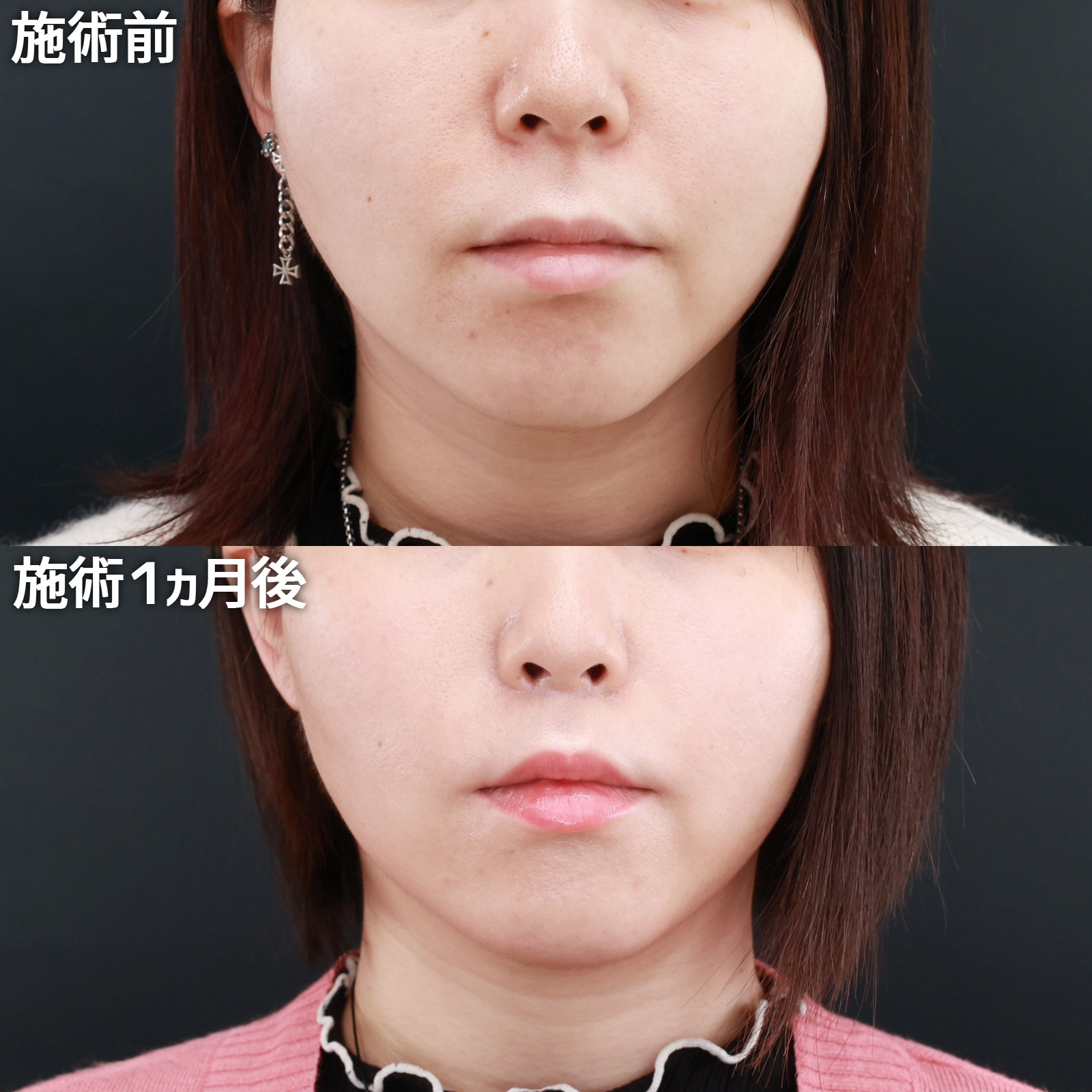 人中短縮術(リップリフト)・外側人中短縮術の症例写真 施術前後