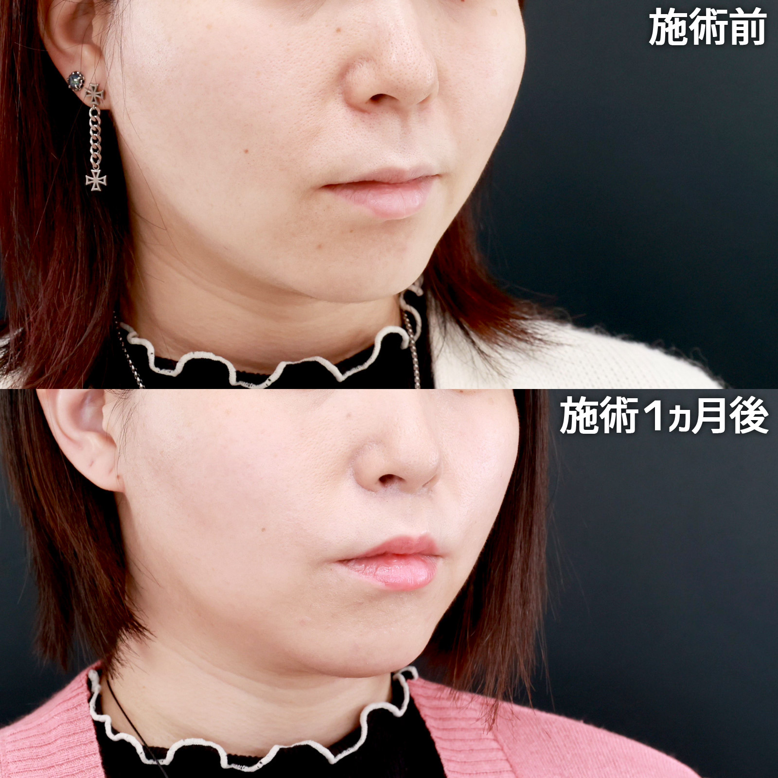 人中短縮術(リップリフト)・外側人中短縮術の症例写真 施術前後