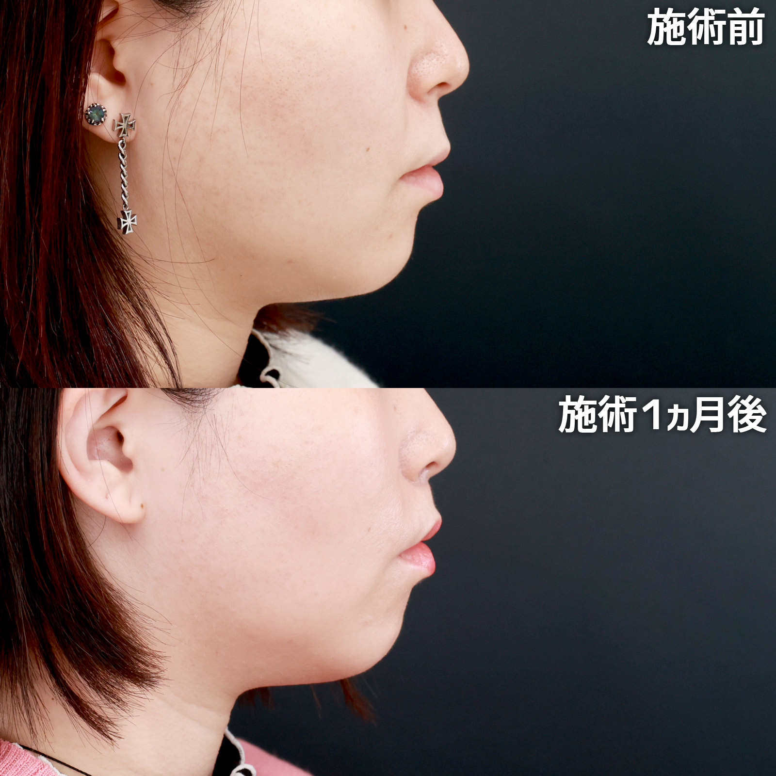 人中短縮術(リップリフト)・外側人中短縮術の症例写真 施術前後