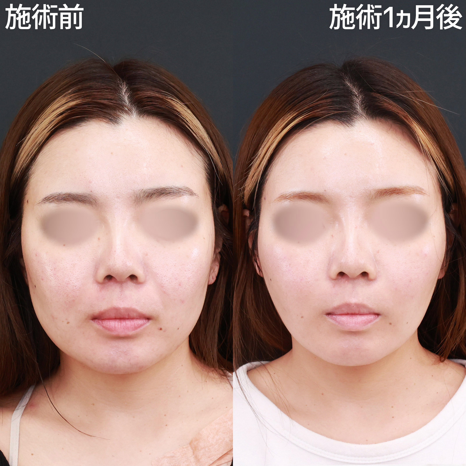 【糸リフト極＆小顔注射】エラ張りを改善して、輪郭スッキリ！