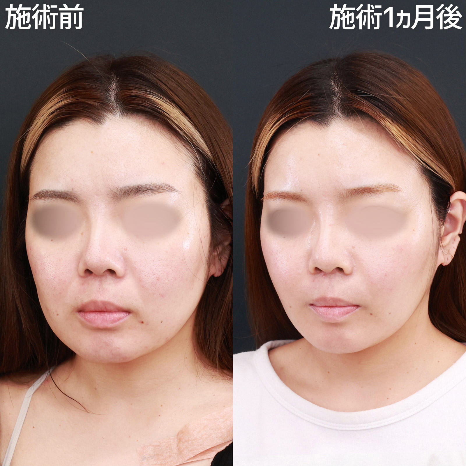 エラボトックス注射/TAC式 ツヤ肌コラーゲンリフト®/ほうれい線のヒアルロン酸注射の症例写真 施術前後 