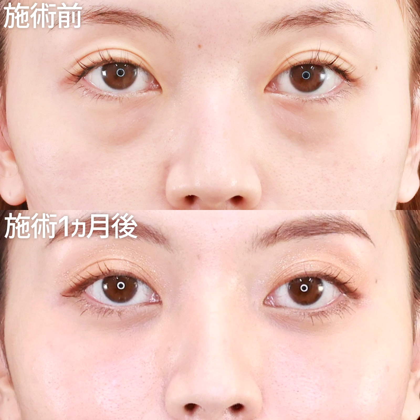 【クマ取り脂肪注入】目元の印象を明るくして、美人度アップ！