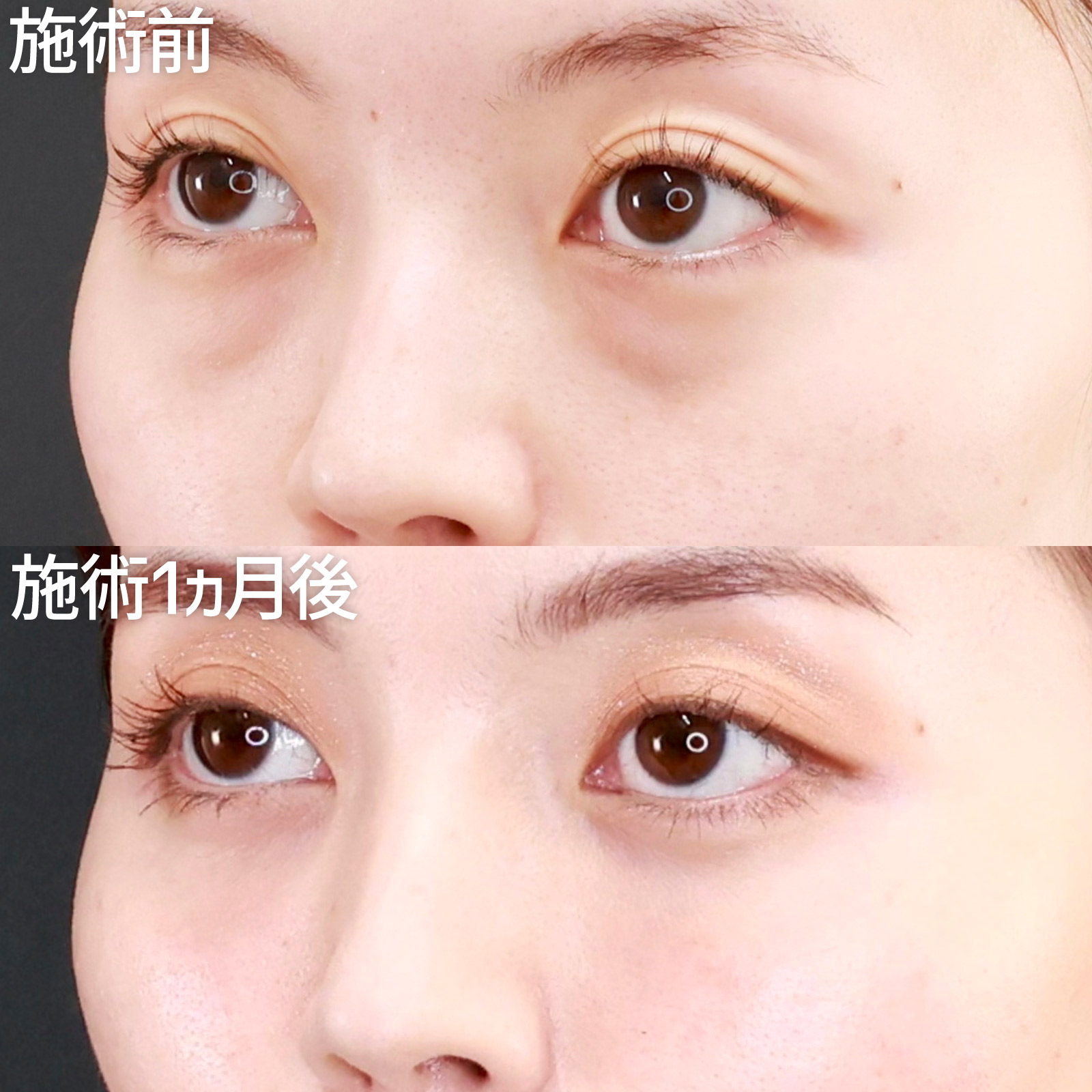 下眼瞼脱脂術（目の下のたるみ取り・目の下の脂肪ふくらみ取り）/顔の脂肪注入(コンデンスリッチフェイス)の症例写真 施術前後 