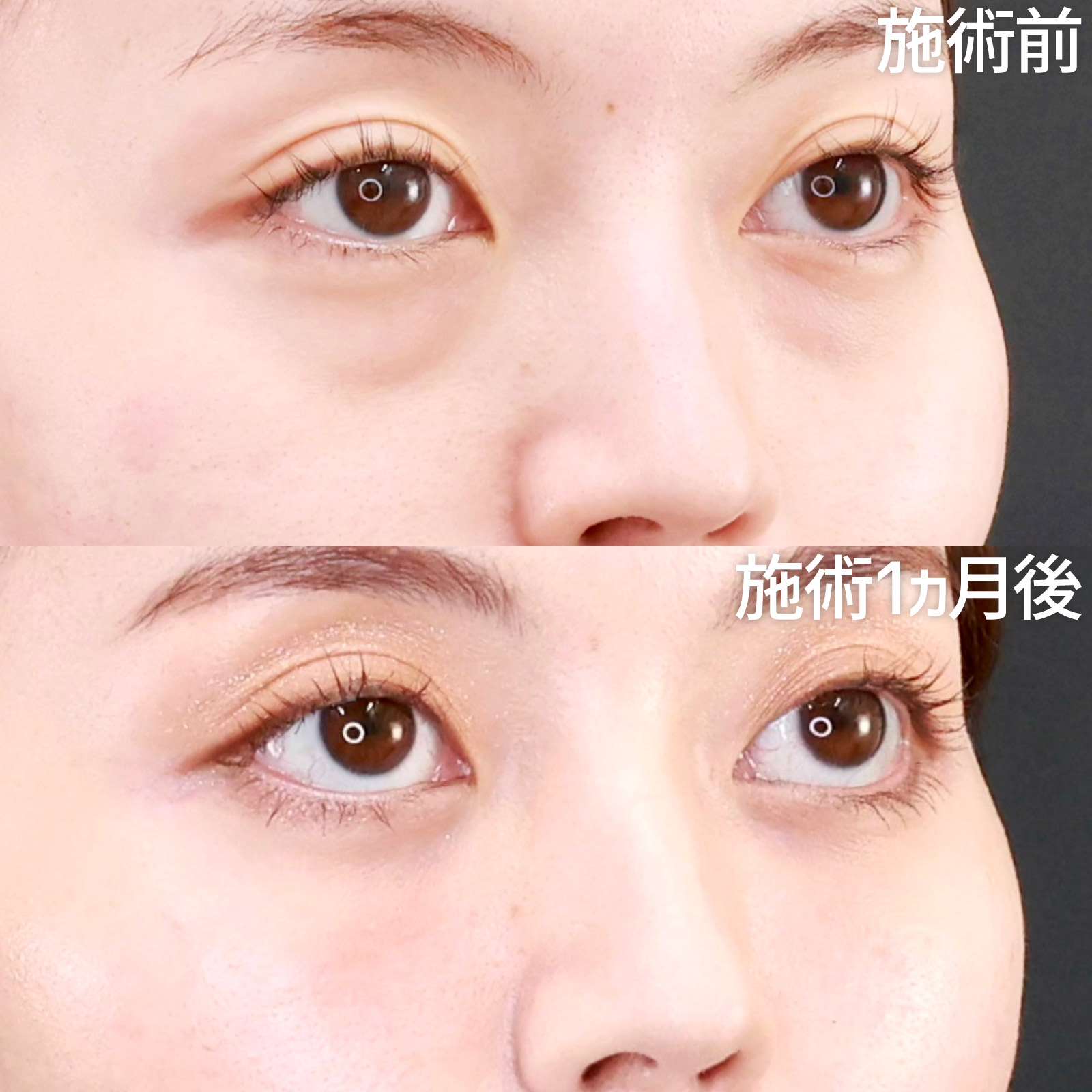 下眼瞼脱脂術（目の下のたるみ取り・目の下の脂肪ふくらみ取り）/顔の脂肪注入(コンデンスリッチフェイス)の症例写真 施術前後 