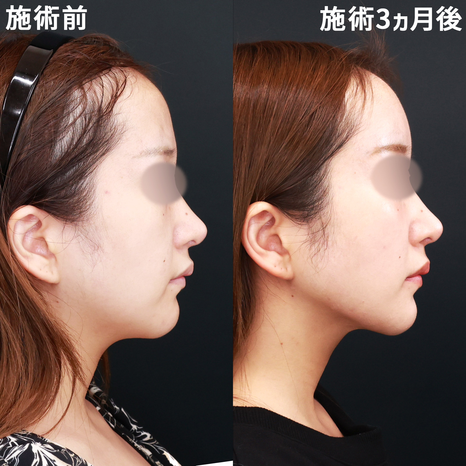 TAC式 ツヤ肌コラーゲンリフト®/顔の脂肪吸引/Lラインファット除去（エラ下脂肪除去）の症例写真 施術前後 