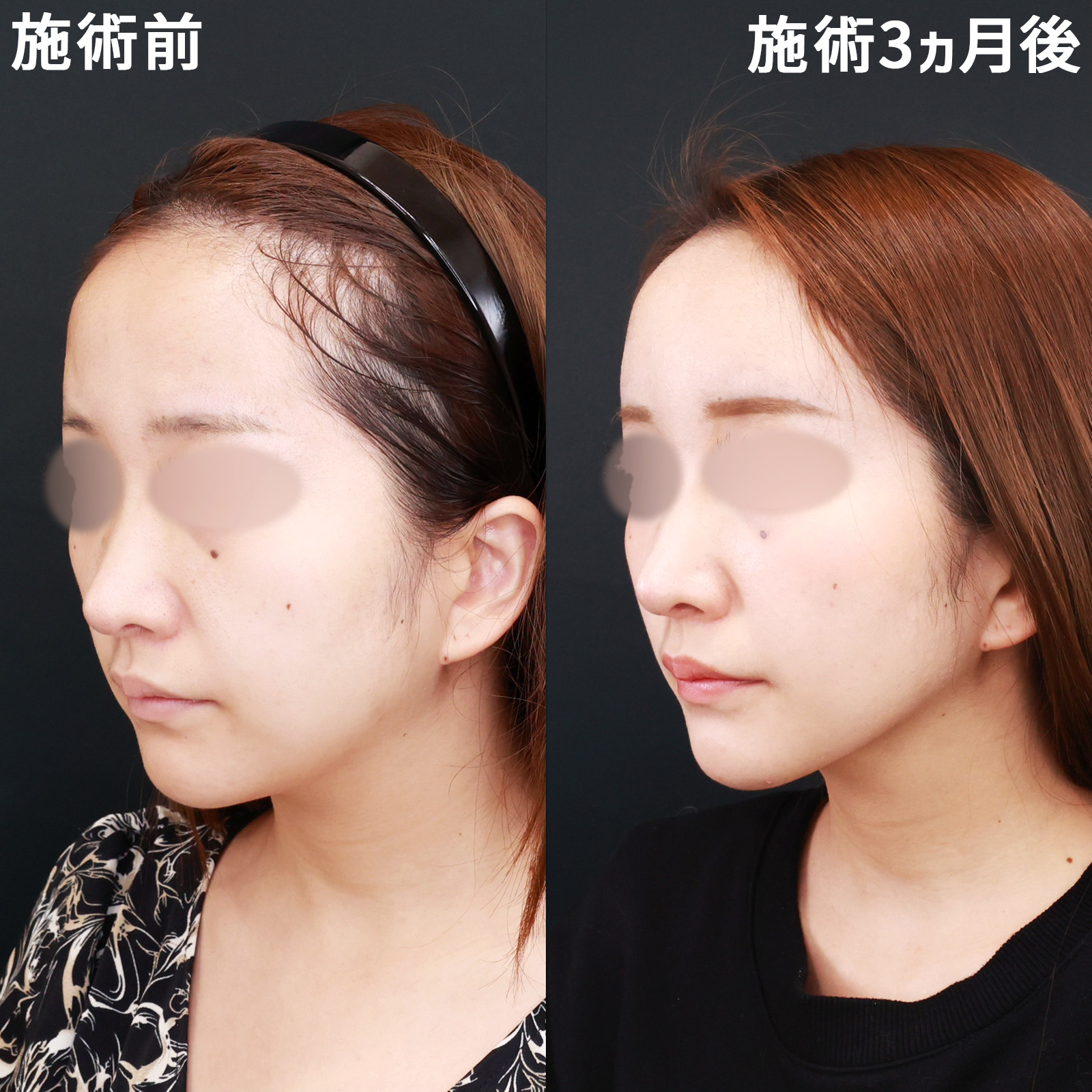 【糸リフト極＆脂肪注入】脂肪の足し算引き算で、洗練されたお顔立ちに