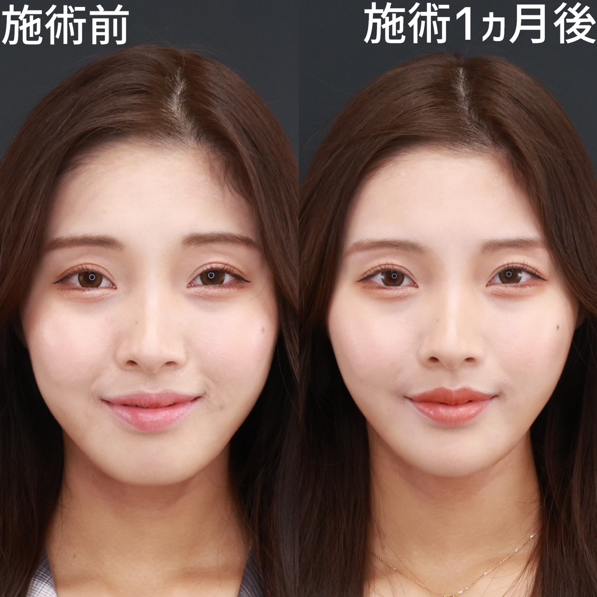 【糸リフト】面長な印象を即日で変える！