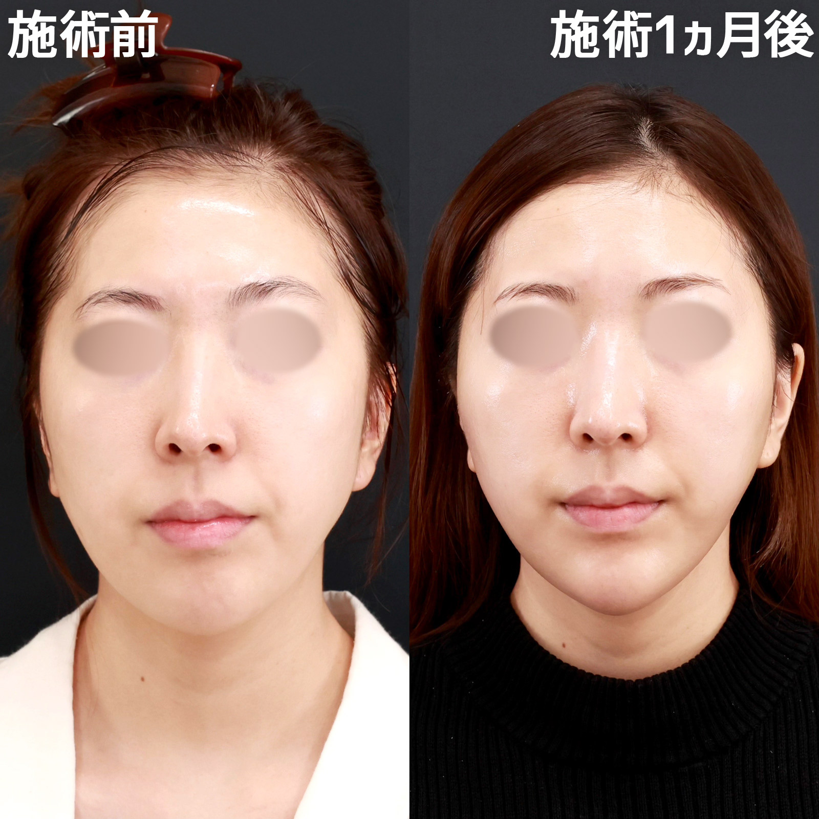 【小顔複合施術】パーフェクトフェイスラインで無駄のないVラインの輪郭形成