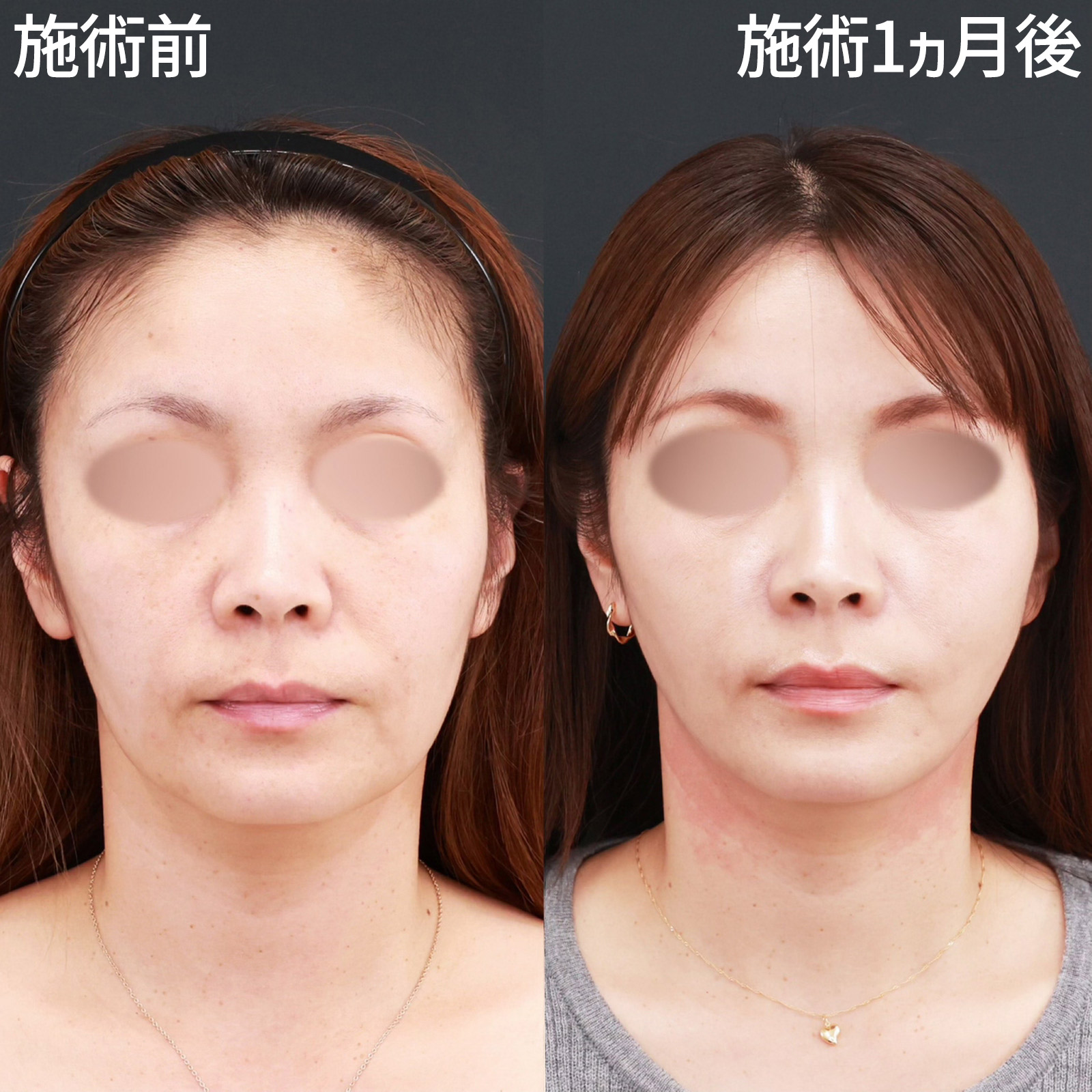 【糸リフト極＆法令線ヒアルロン酸】ダウンタイムも少なく、確実に若返る！