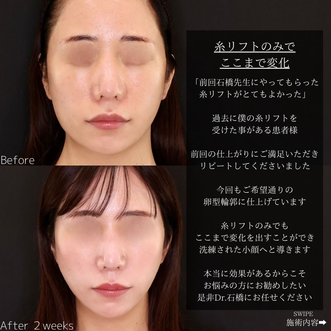 TAC式 ツヤ肌コラーゲンリフト®の症例写真 施術前後 