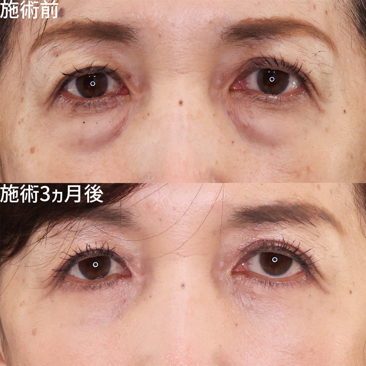 下眼瞼切開術（クマ・たるみとり）/下眼瞼脱脂術（目の下のたるみ取り・目の下の脂肪ふくらみ取り）の症例写真 施術前後 