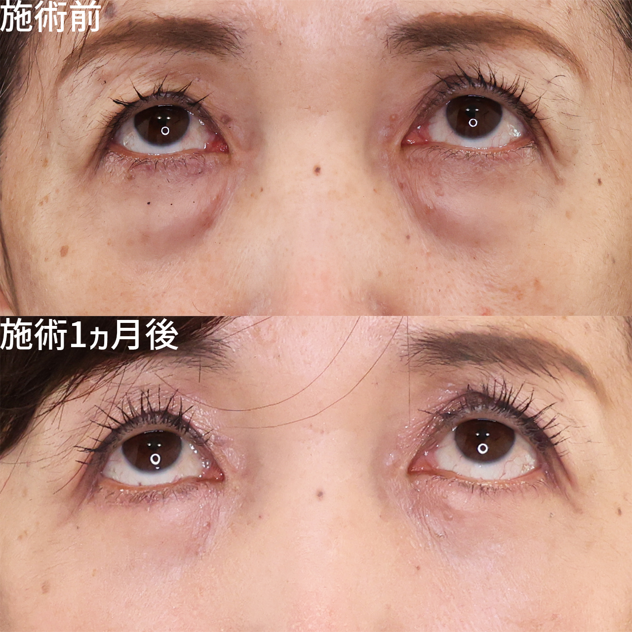 下眼瞼切開術（クマ・たるみとり）/下眼瞼脱脂術（目の下のたるみ取り・目の下の脂肪ふくらみ取り）の症例写真 施術前後 