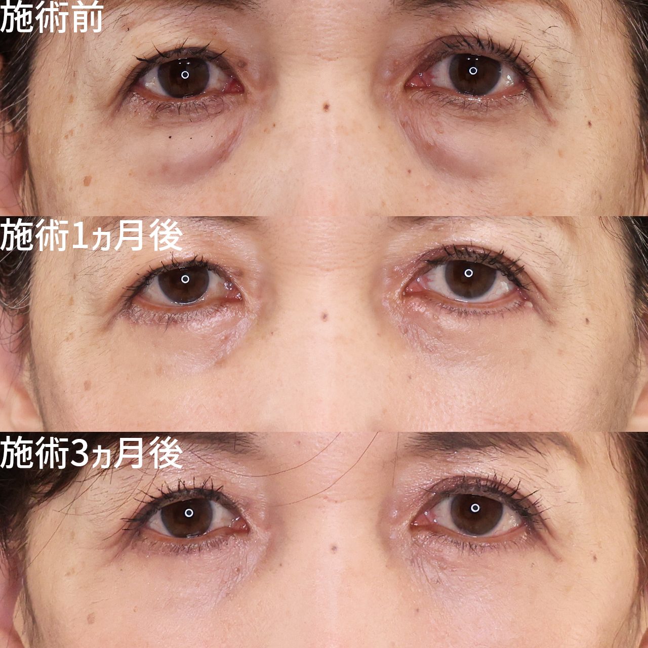 下眼瞼切開術（クマ・たるみとり）/下眼瞼脱脂術（目の下のたるみ取り・目の下の脂肪ふくらみ取り）の症例写真 施術前後 