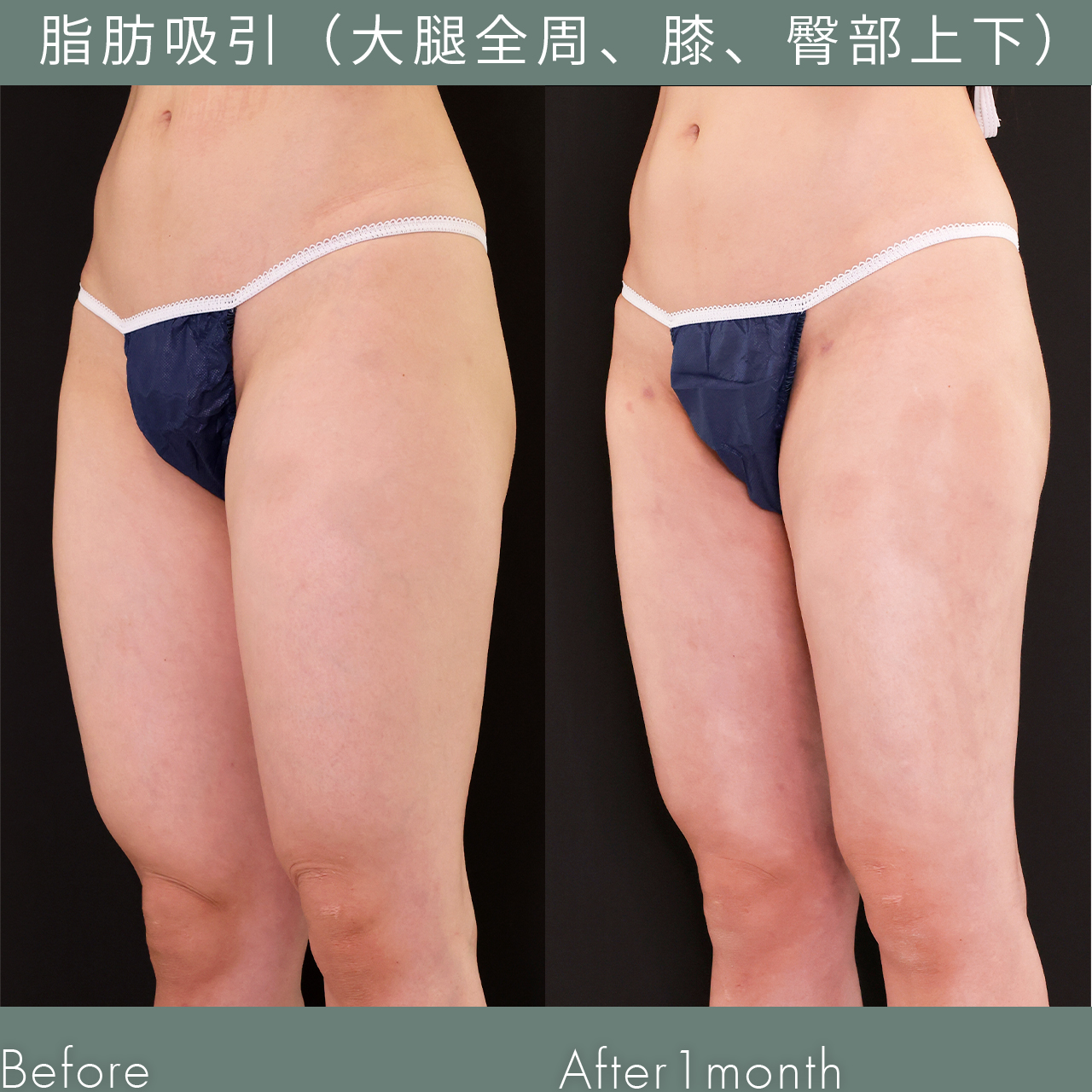 顔の脂肪吸引/脂肪注入豊胸（コンデンスリッチ・ピュアグラフト・１day脂肪豊胸）の症例写真 施術前後 