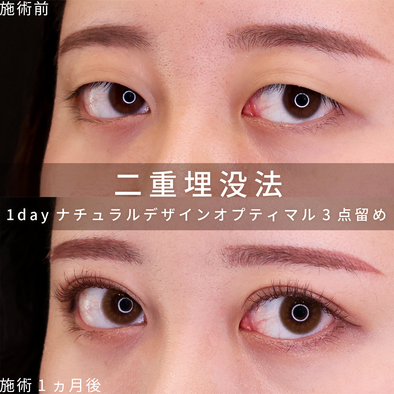 二重埋没法の症例写真 施術前後 