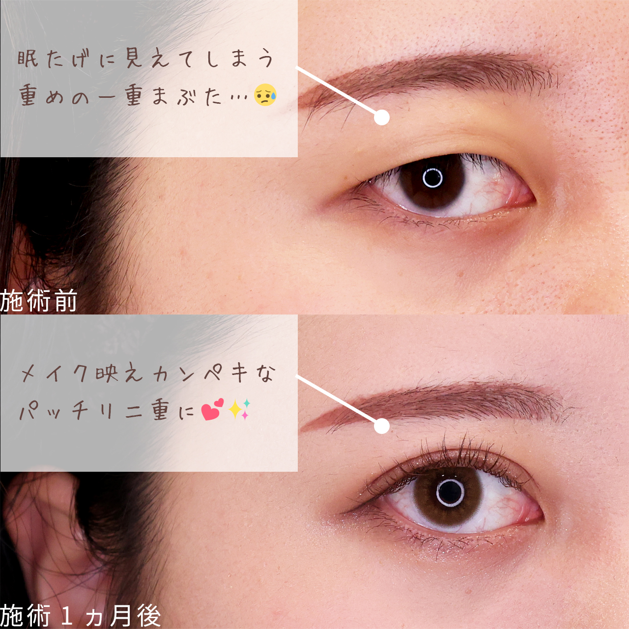 二重埋没法の症例写真 施術前後 