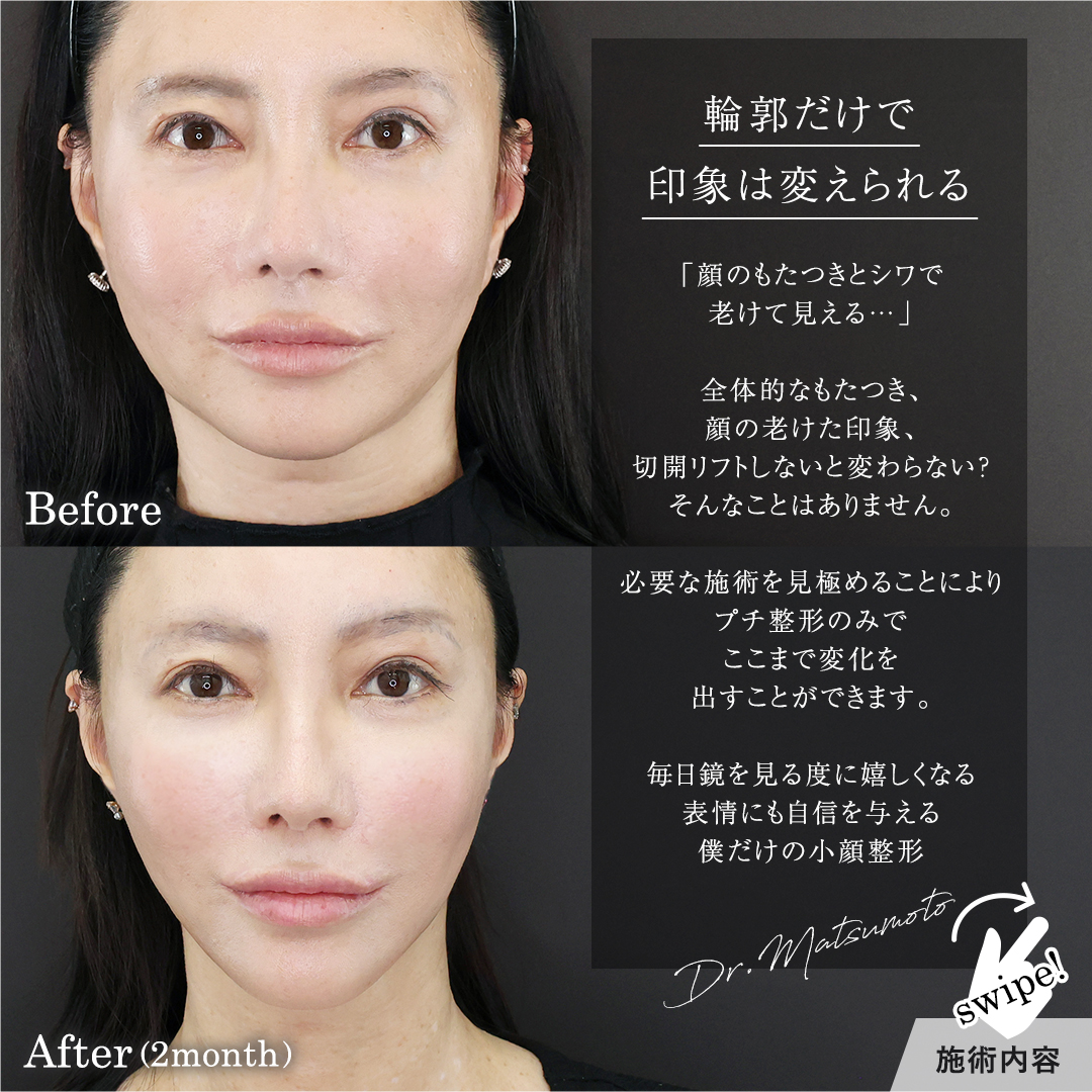 目の下のヒアルロン酸注射/TAC式 ツヤ肌コラーゲンリフト®の症例写真 施術前後 