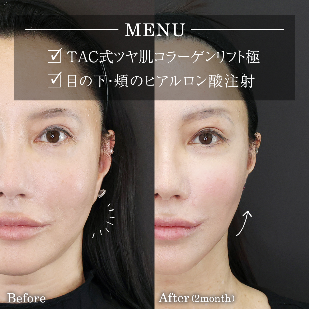 目の下のヒアルロン酸注射/TAC式 ツヤ肌コラーゲンリフト®の症例写真 施術前後 