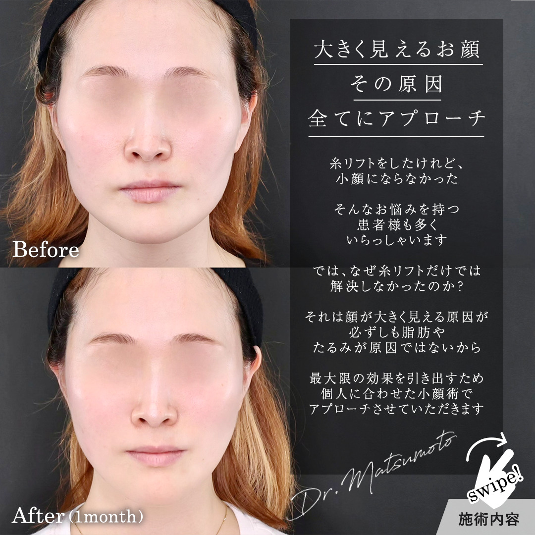 TAC式 ツヤ肌コラーゲンリフト®/エラボトックス注射の症例写真 施術前後 