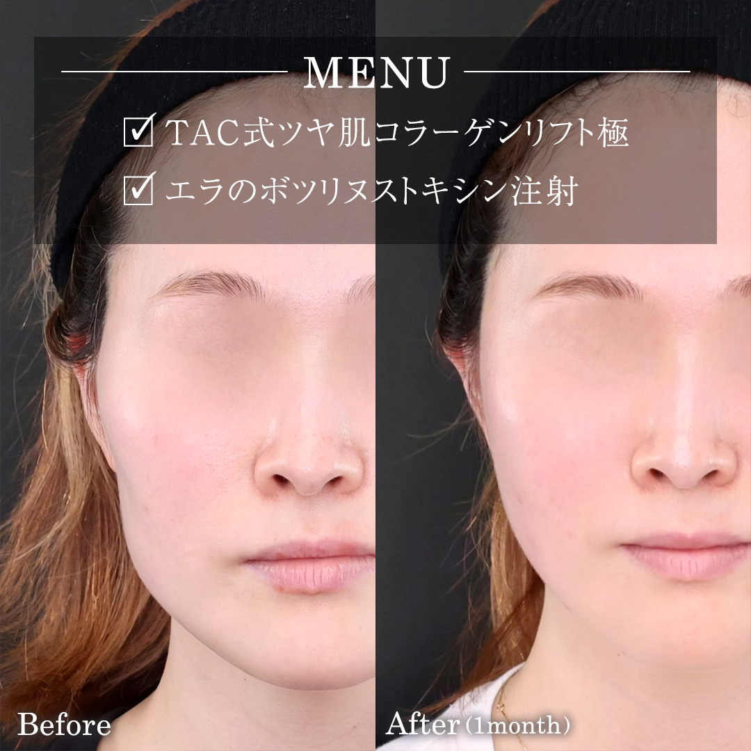 TAC式 ツヤ肌コラーゲンリフト®/エラボトックス注射の症例写真 施術前後 